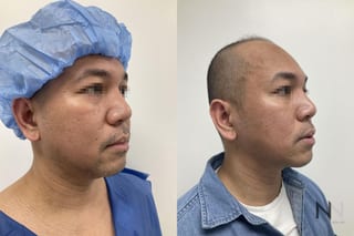 Submental liposuction showing improved jawline contour - Angle 4
