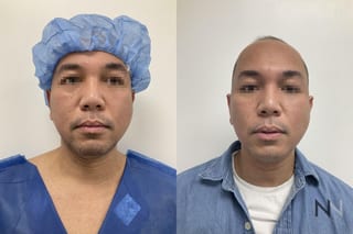 Submental liposuction showing improved jawline contour - Angle 3