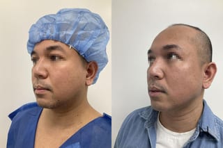 Submental liposuction showing improved jawline contour - Angle 2
