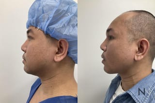 Submental liposuction showing improved jawline contour - Angle 1