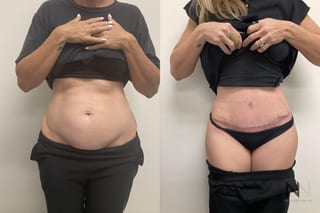 Waistline definition after abdominoplasty procedure - Angle 1