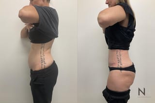 Waistline definition after abdominoplasty procedure - Angle 4