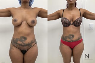 Before and after VASER liposuction with J-Plasma six months results - Angle 3