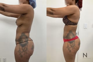 Before and after VASER liposuction with J-Plasma six months results - Angle 1