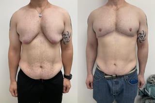 Before and after gynecomastia lift showing reduced male breast tissue and improved chest contour four months after surgery. - Angle 1