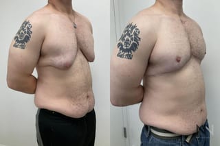 Before and after gynecomastia lift showing reduced male breast tissue and improved chest contour four months after surgery. - Angle 4