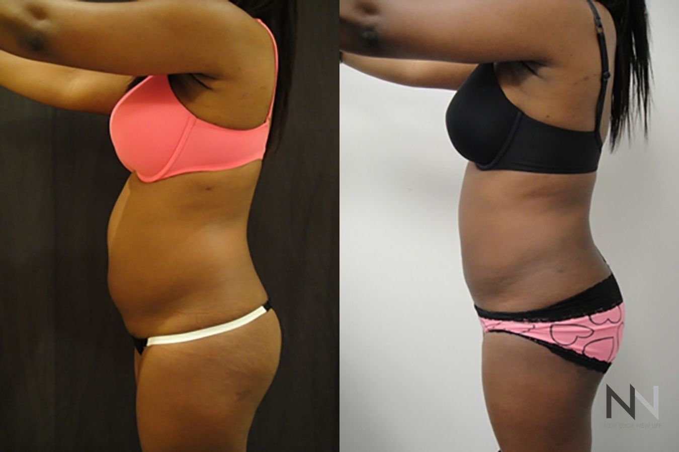 Liposuction 360 showing improved waistline definition - Angle 2