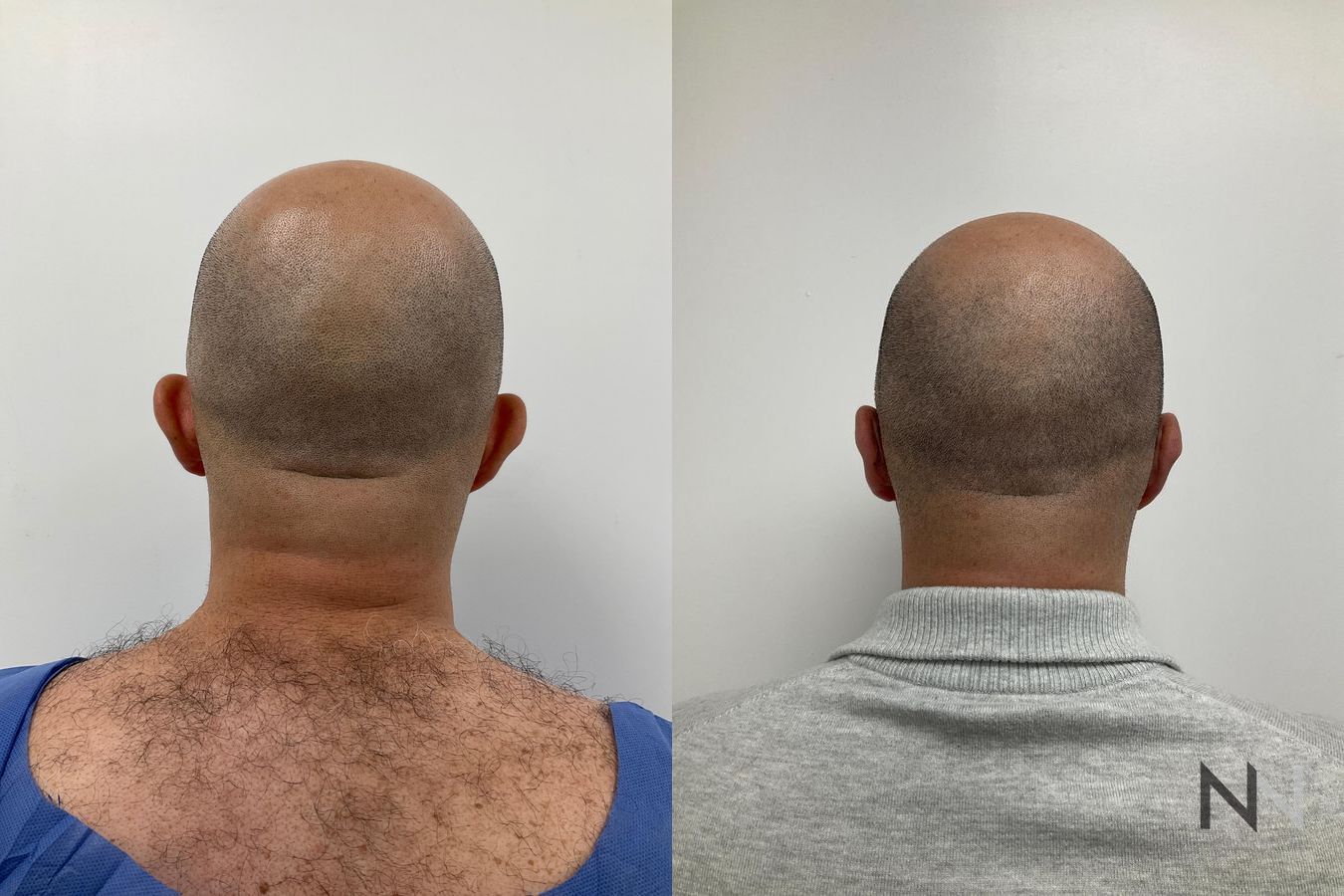 Male otoplasty before and after ear alignment improvement