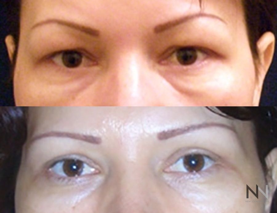 Before and after blepharoplasty four months results
