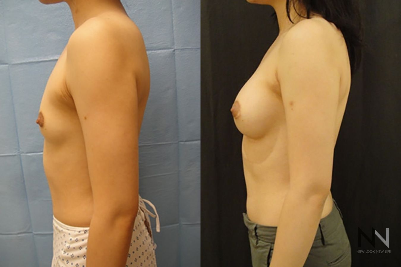 Breast augmentation results with improved projection - Angle 4