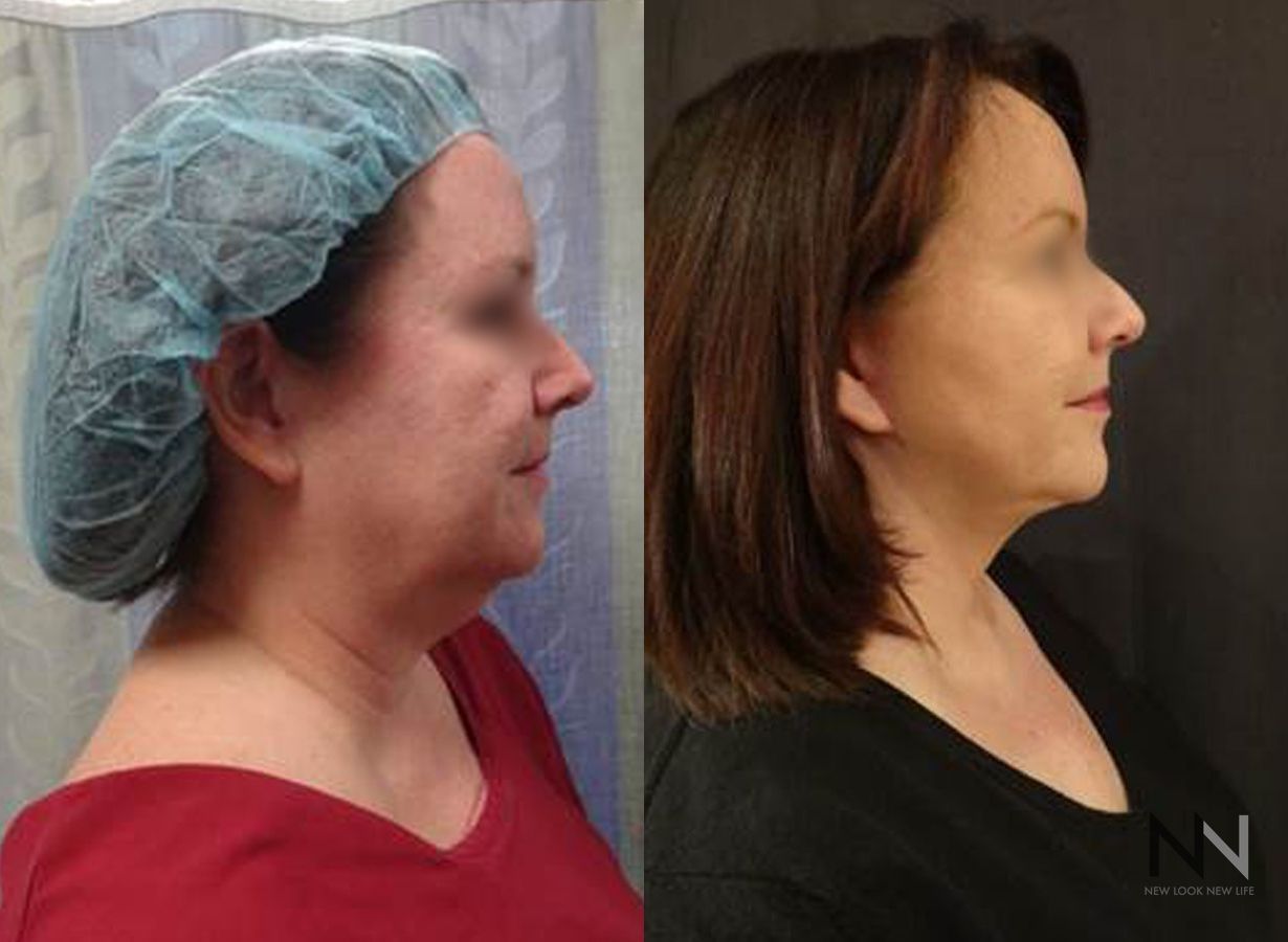 Facelift and neck lift showing improved jawline definition