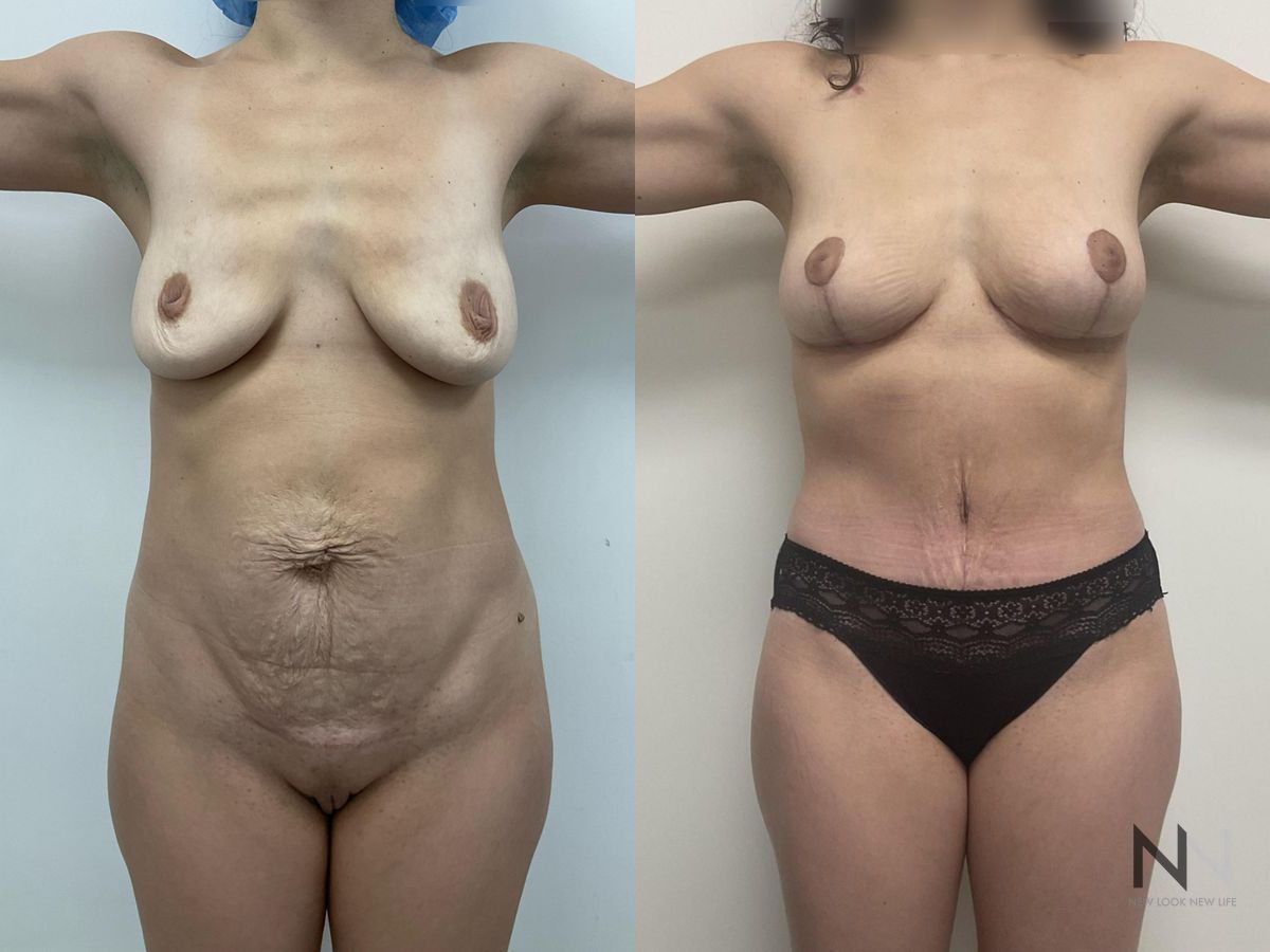 Before and after mommy makeover six months results