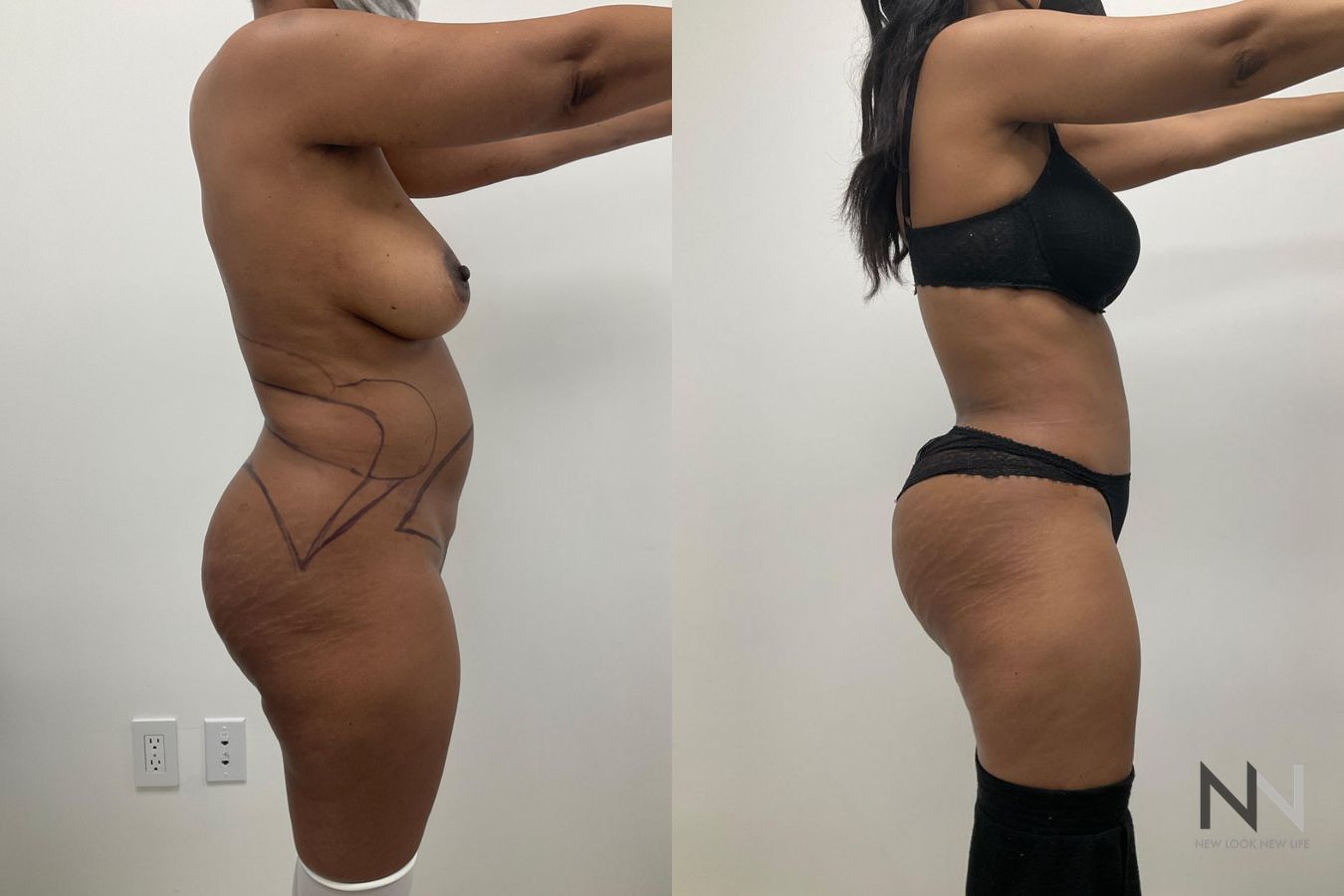 Abdominoplasty and liposuction showing improved contour - Angle 4