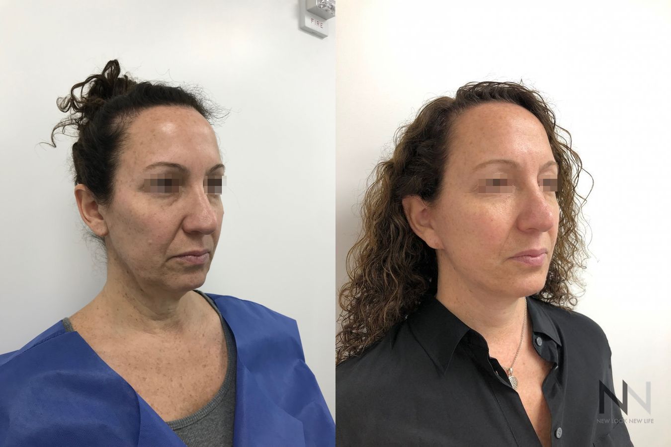 Mini facelift results six months post-op comparison - Angle 4