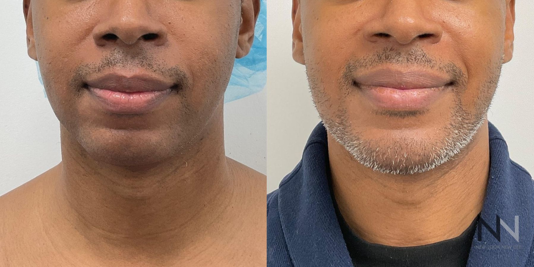 Before and after chin augmentation and chin liposuction six months results - Angle 3