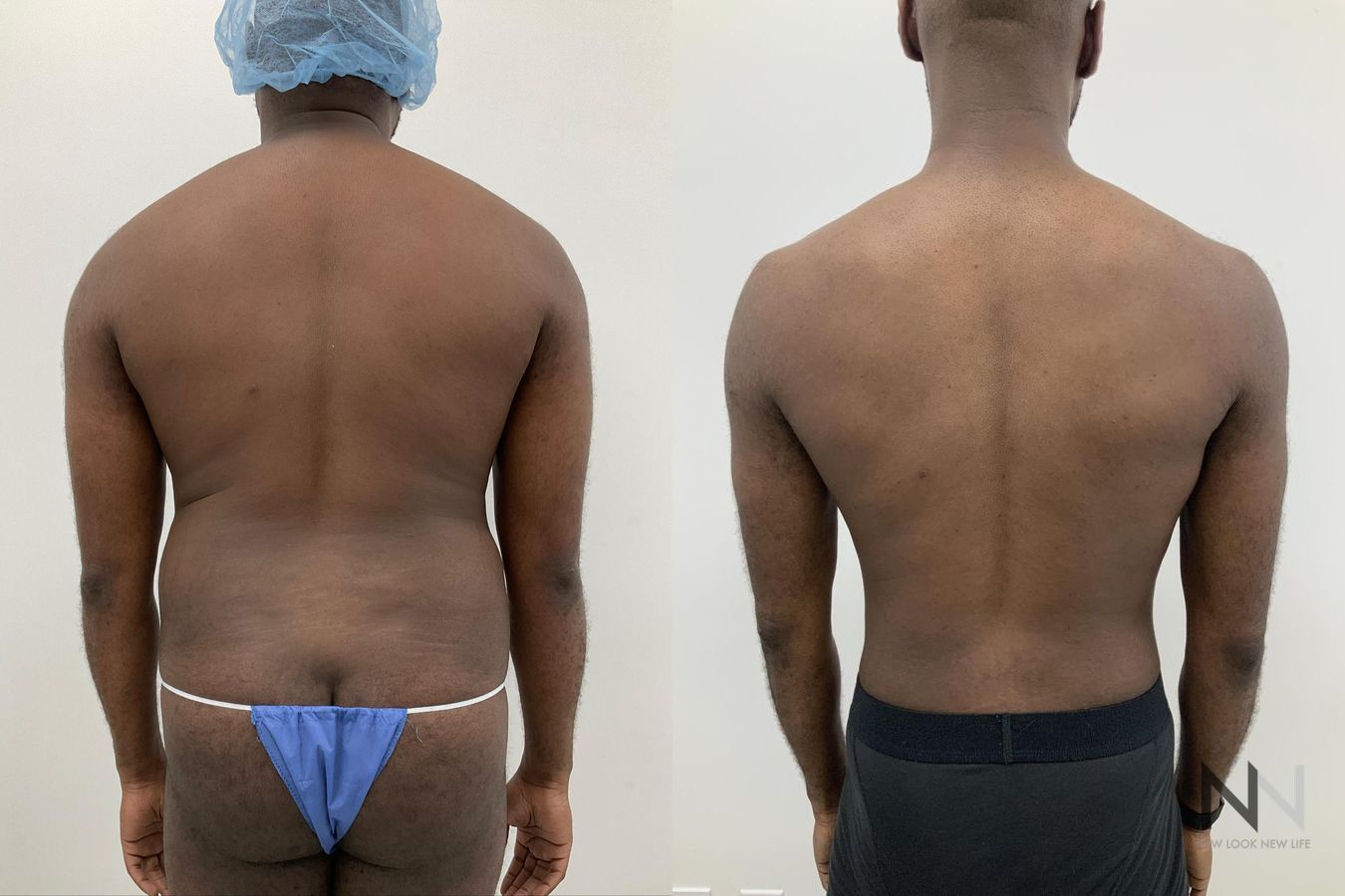 Body contouring with liposuction before and after - Angle 7