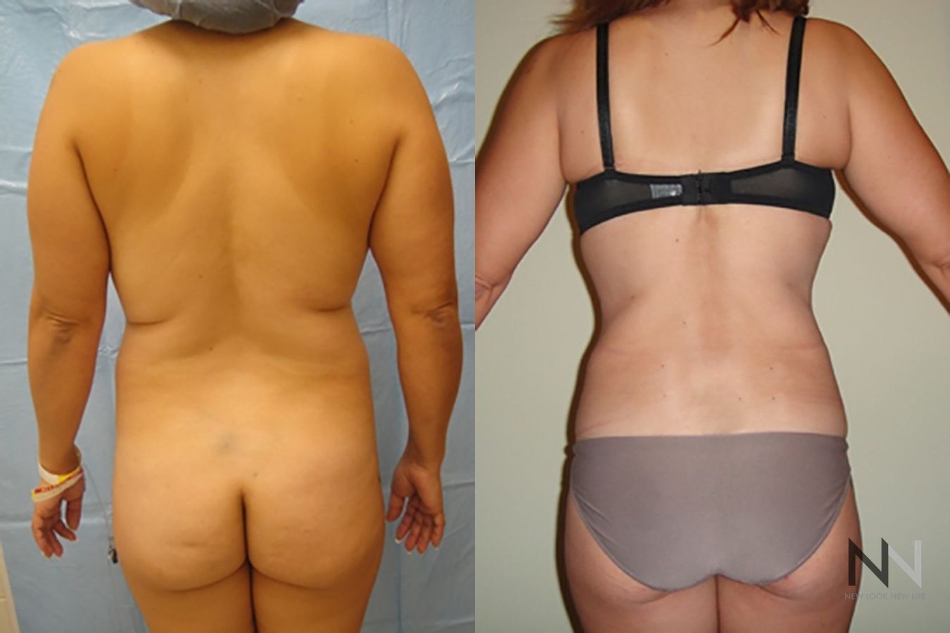 Before and after liposuction six months results - Angle 4