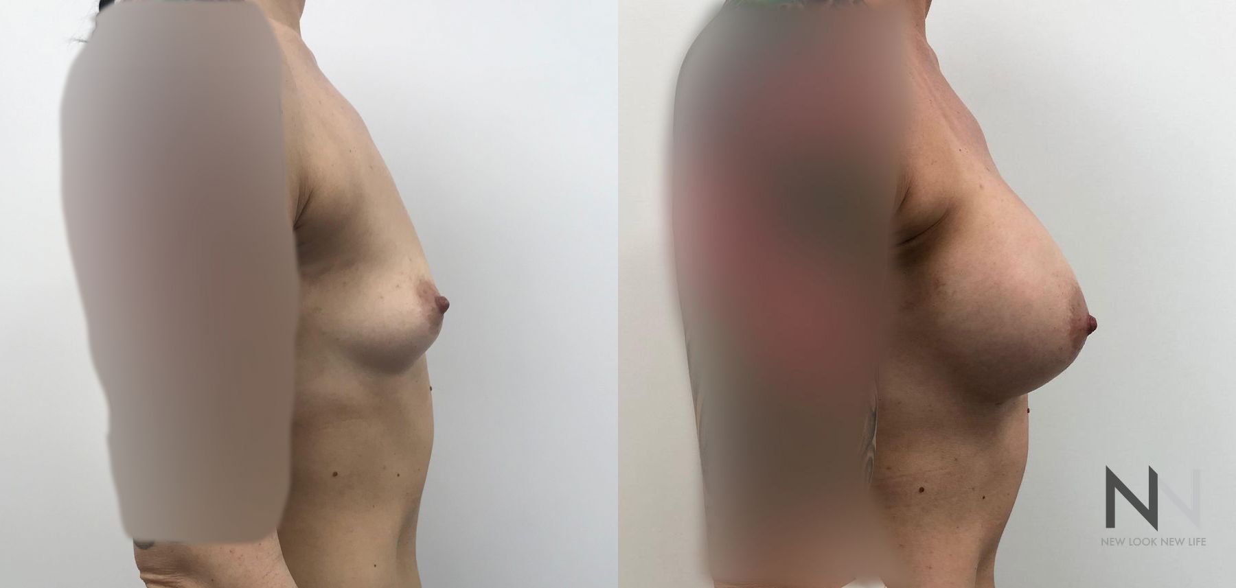 Before and after breast augmentation six months results - Angle 2