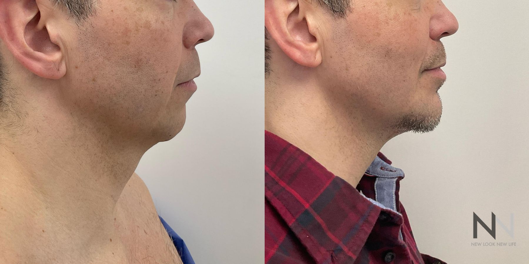 Jawline definition improvement after chin augmentation