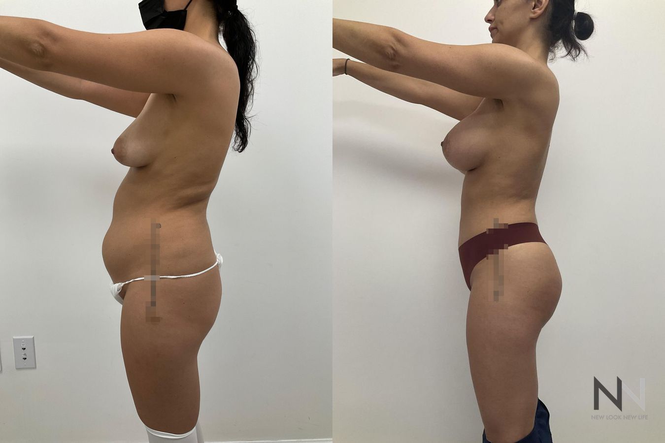 Before and after BBL and liposuction six months results - Angle 3