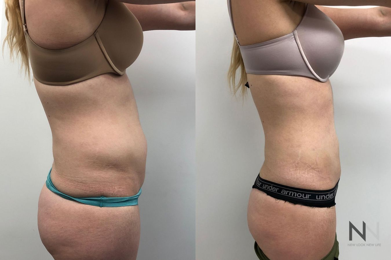 Awake liposuction abdomen and flank contour improvement - Angle 2