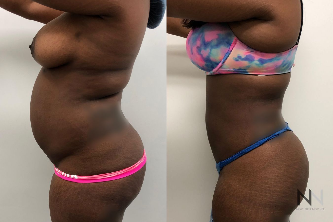 Before and after TICKLE liposuction six months results - Angle 2