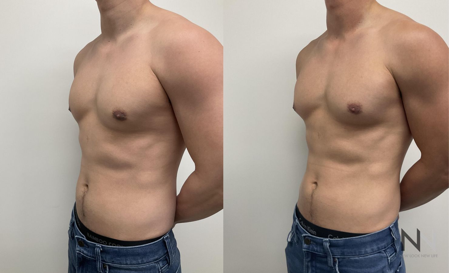 Gynecomastia surgery showing flatter chest contour - Angle 2