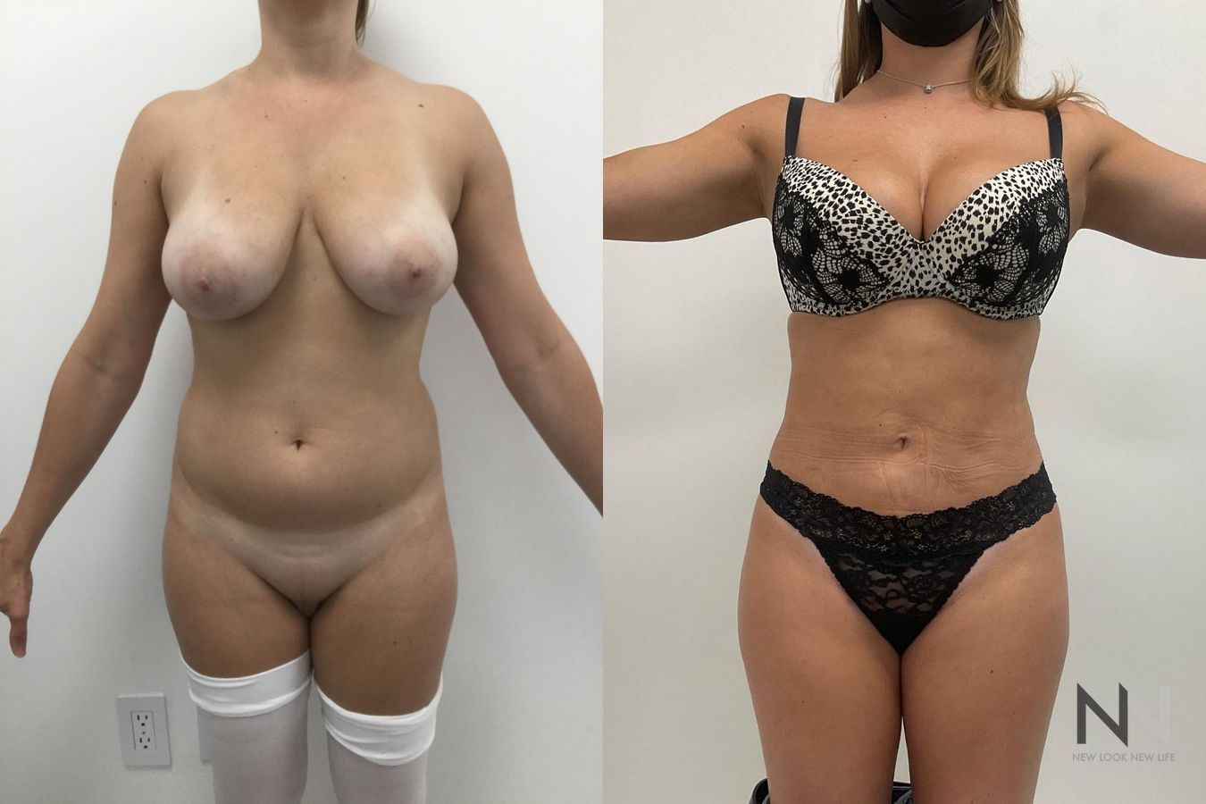Before and after Brazilian Butt Lift six months results - Angle 2