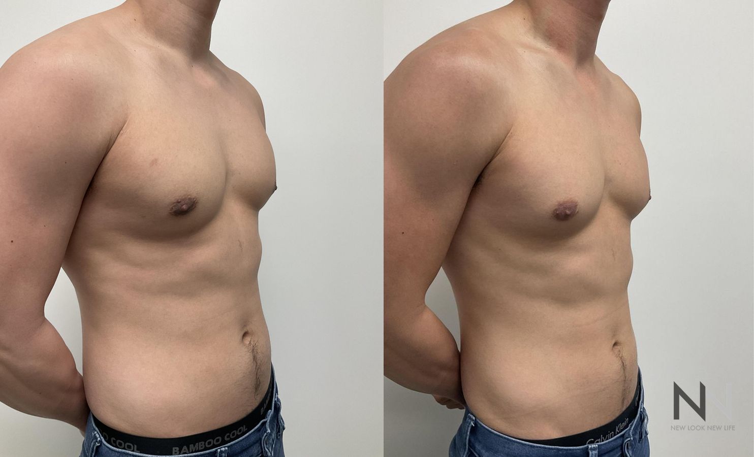 Gynecomastia surgery showing flatter chest contour - Angle 4