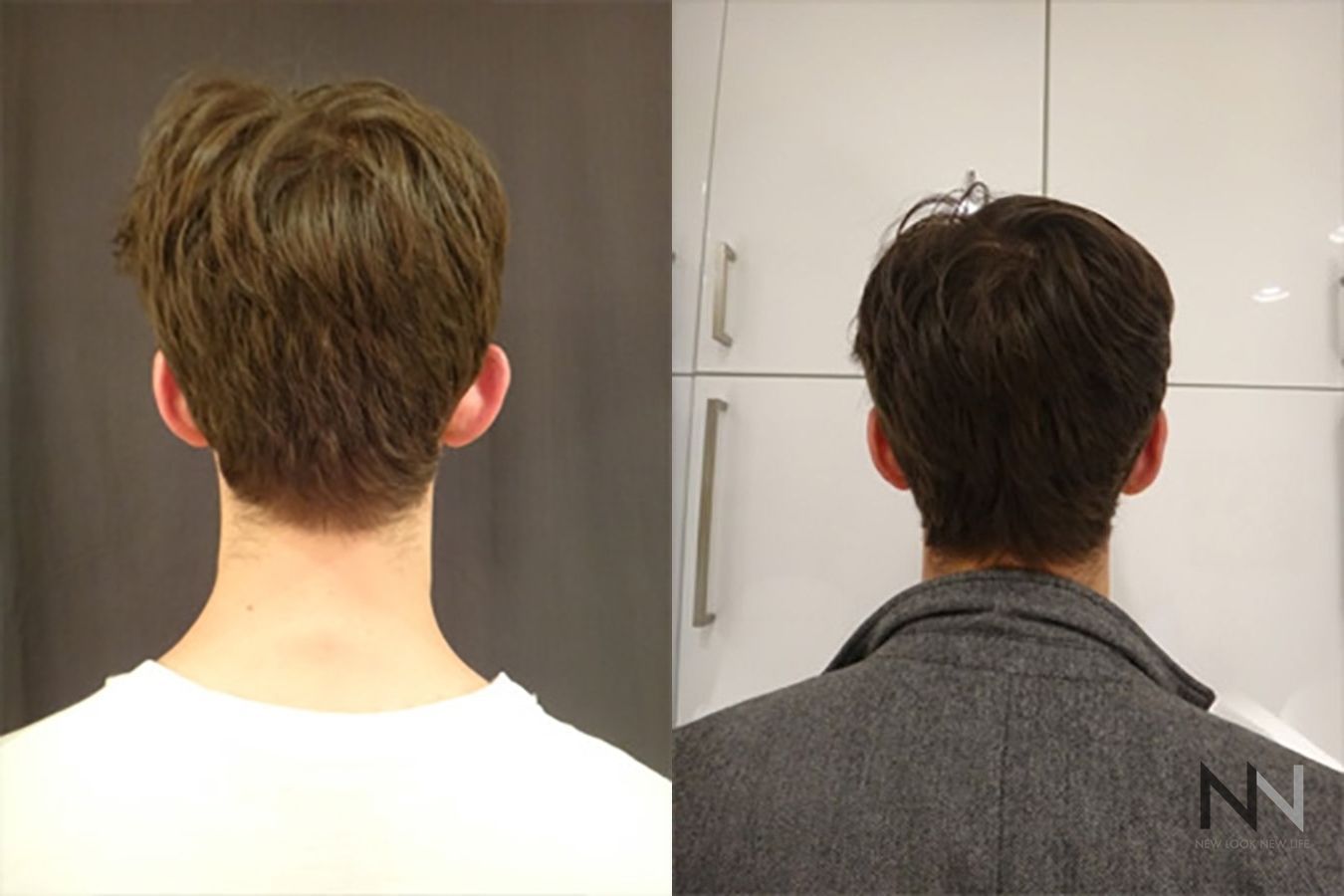 Otoplasty before and after back view comparison