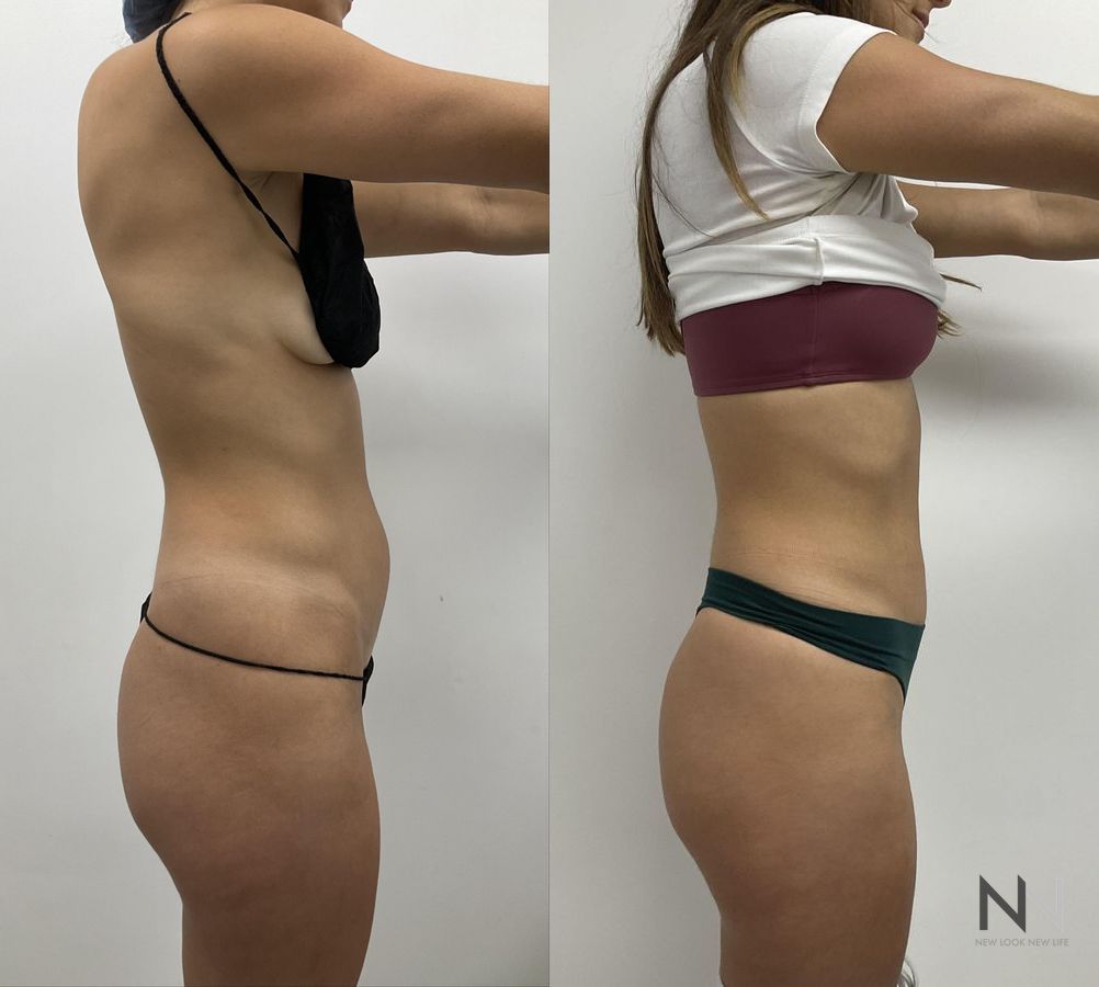 Liposuction of waist and abdomen showing improved contour - Angle 2