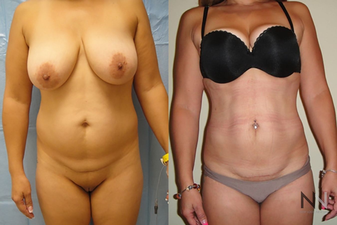 Before and after liposuction six months results