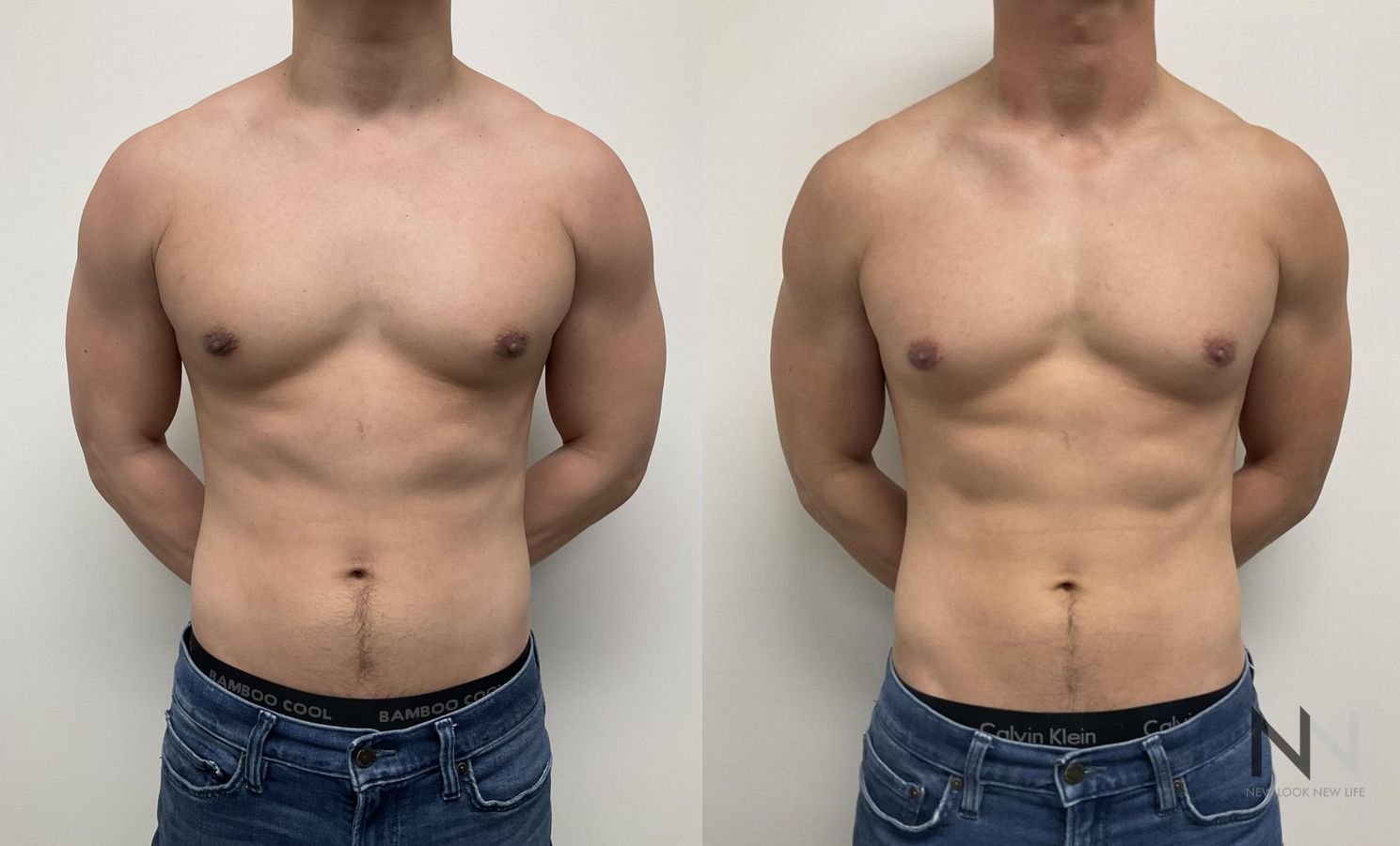 Gynecomastia surgery showing flatter chest contour