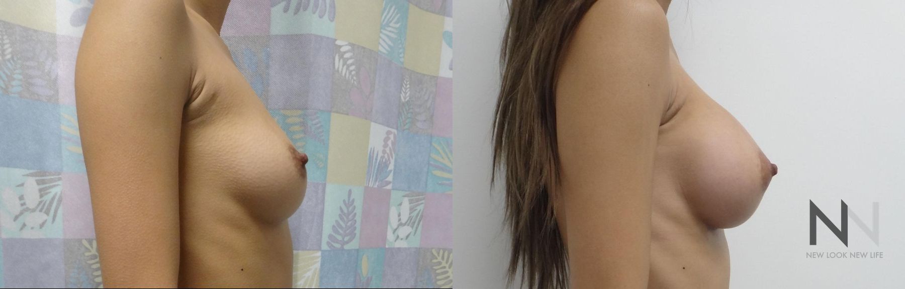 Before and after breast augmentation six months results - Angle 5