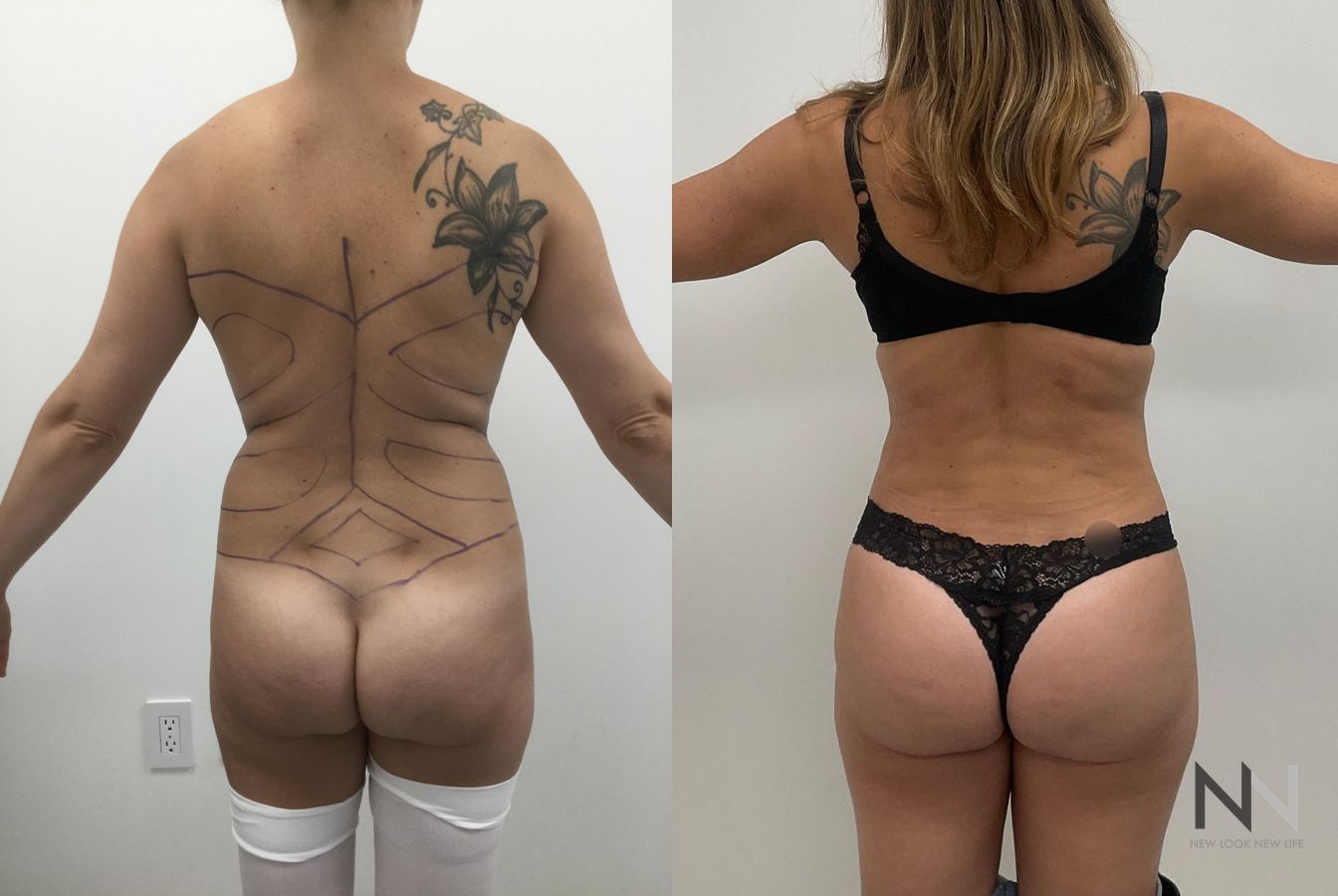 Before and after Brazilian Butt Lift six months results