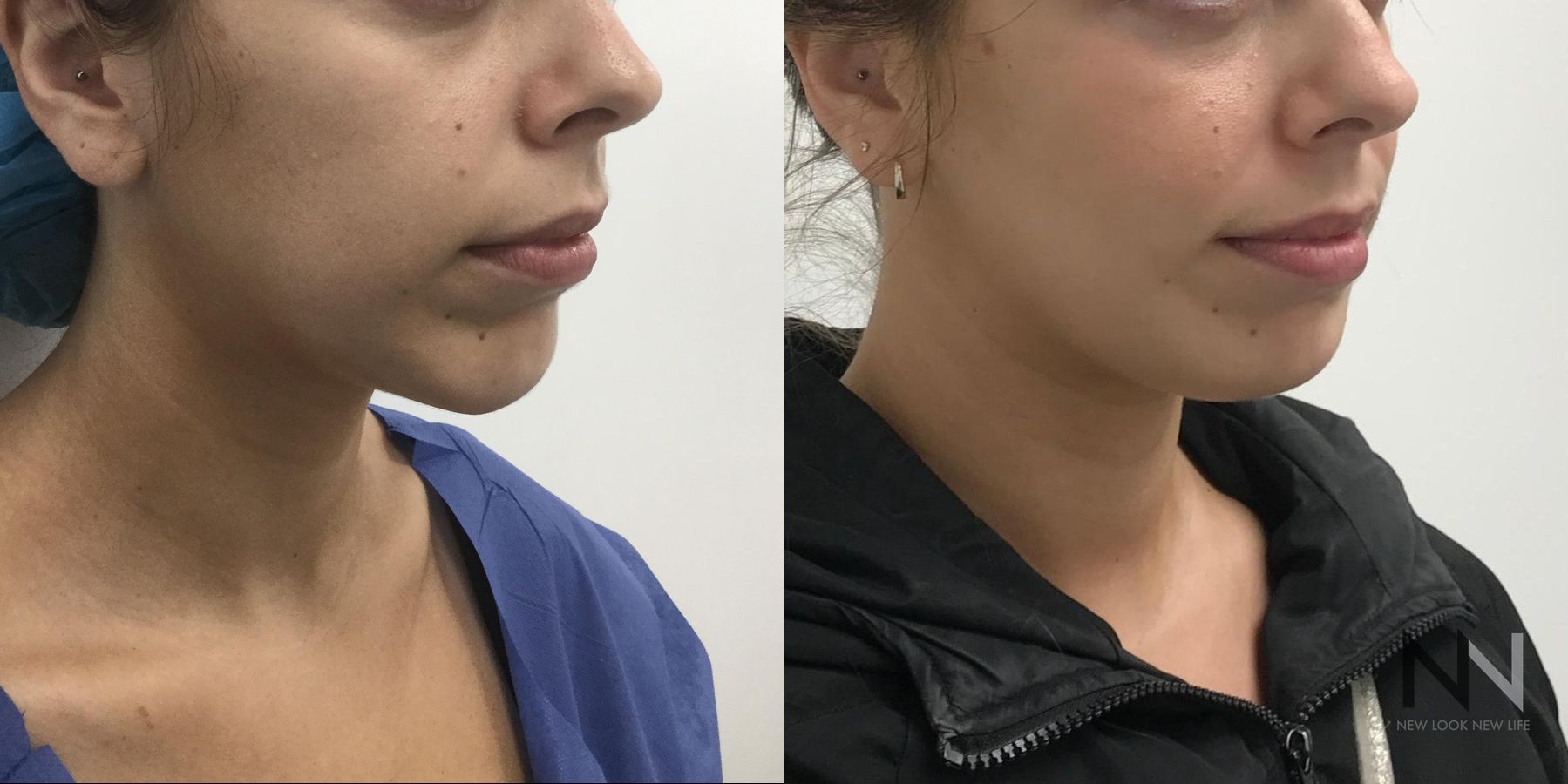 Before and after chin augmentation six months results - Angle 2