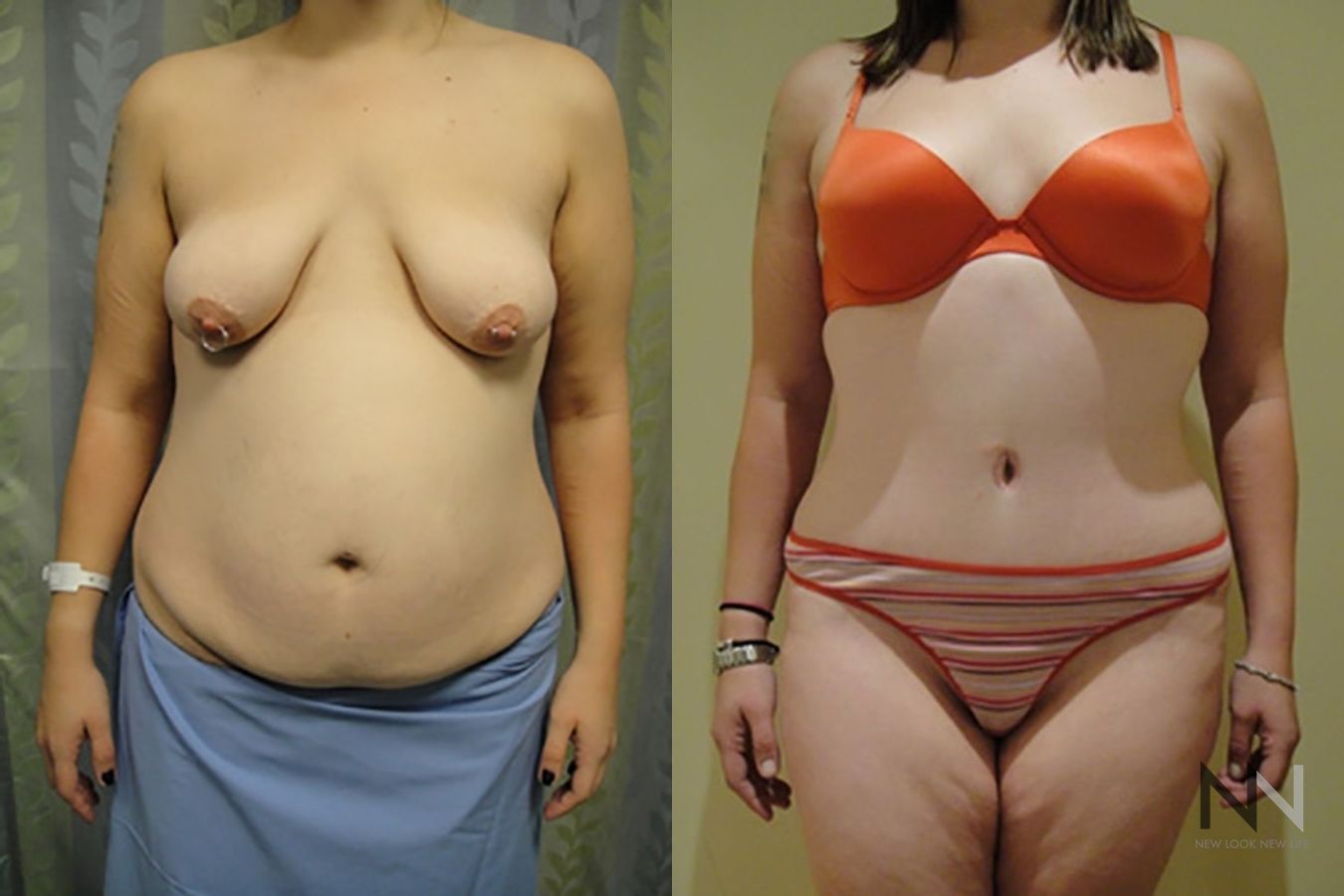 Before and after tummy tuck eight months results