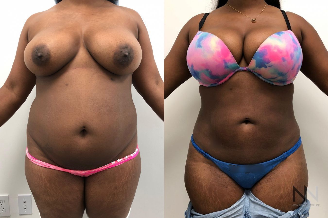 Before and after TICKLE liposuction six months results