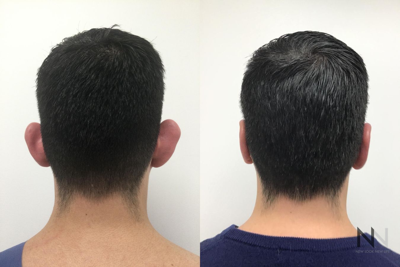 Ear pinning surgery showing reduced ear protrusion