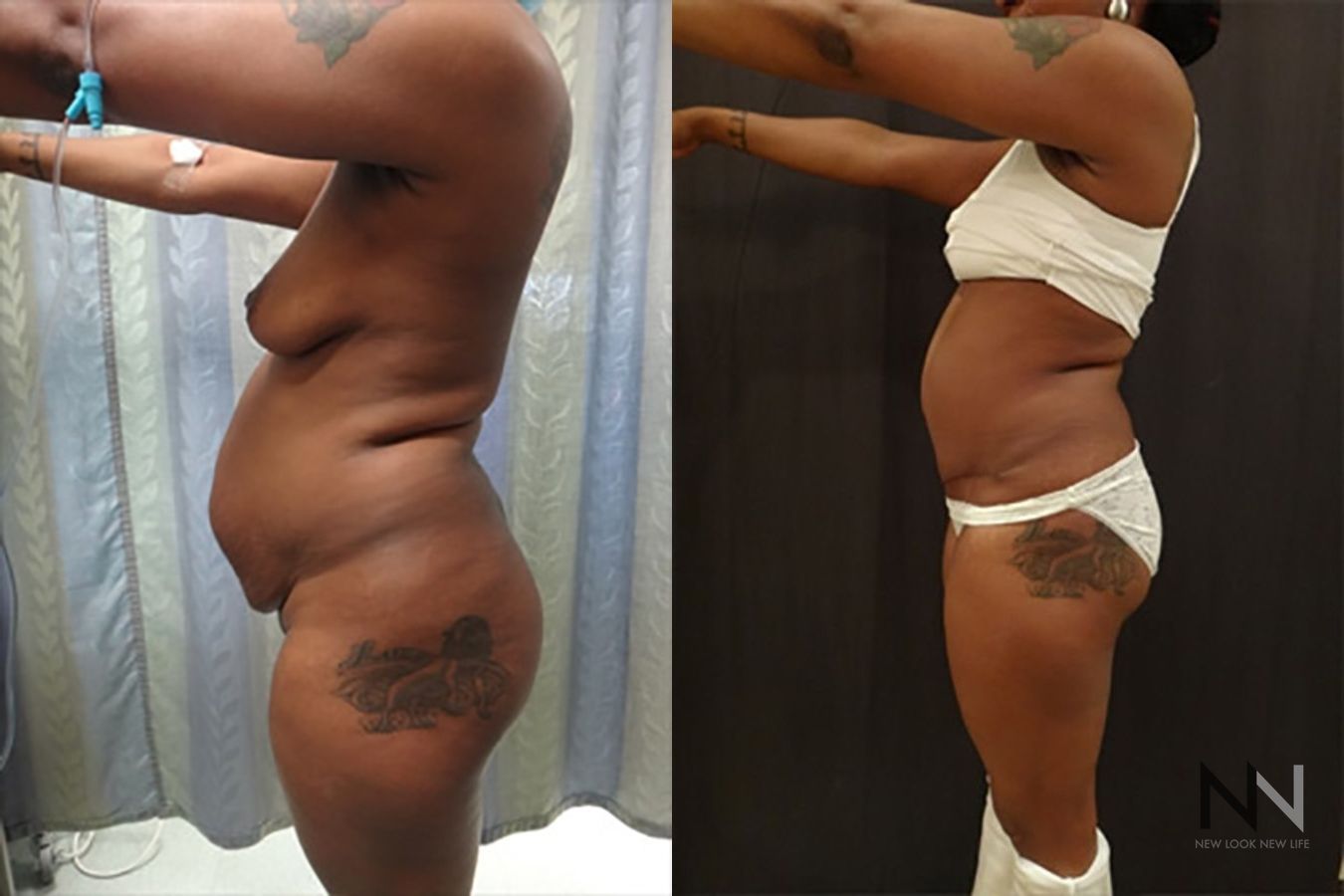 Tummy tuck before and after abdominal contour improvement - Angle 2
