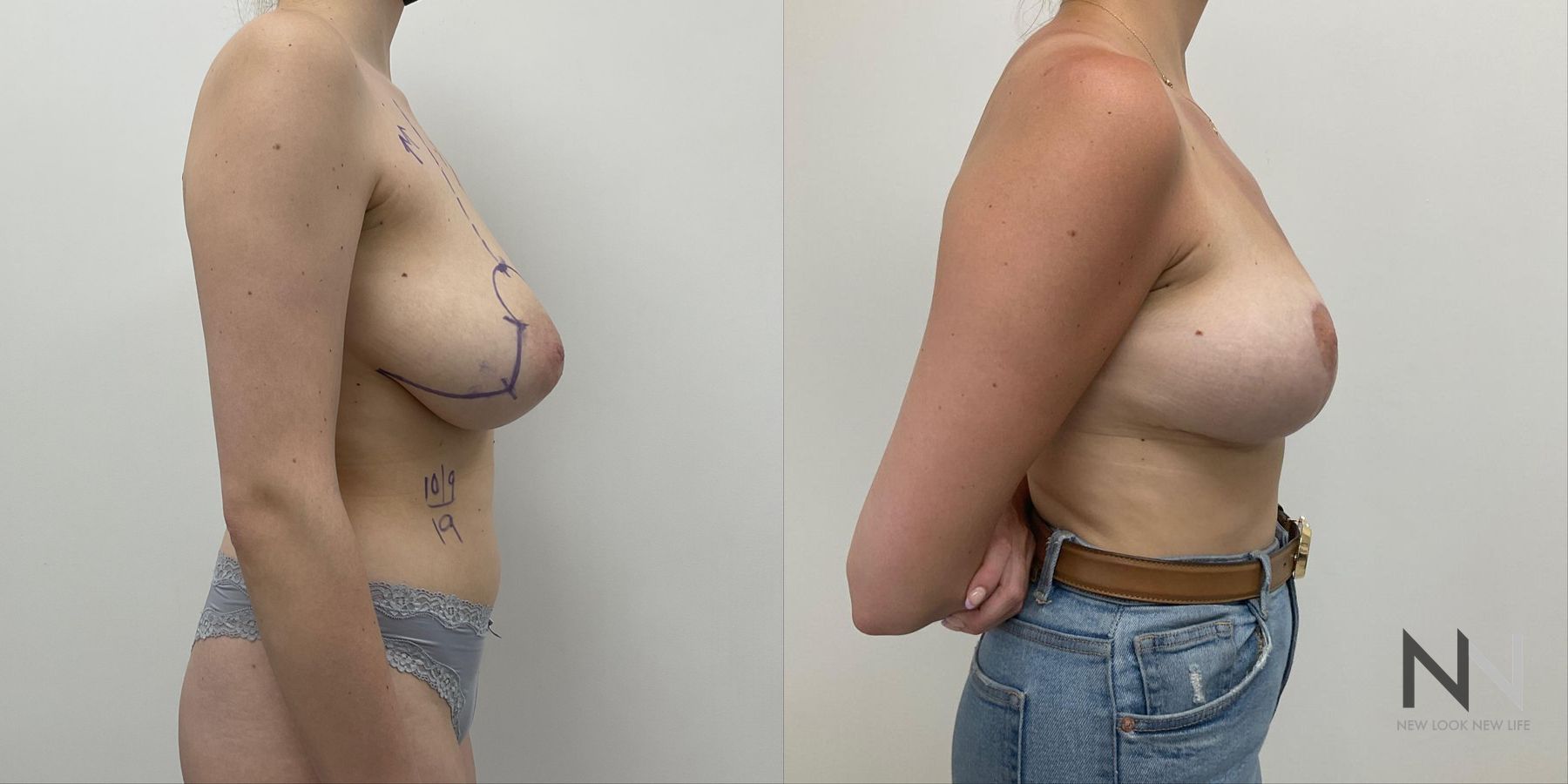 Reduction mammoplasty showing improved breast contour - Angle 2