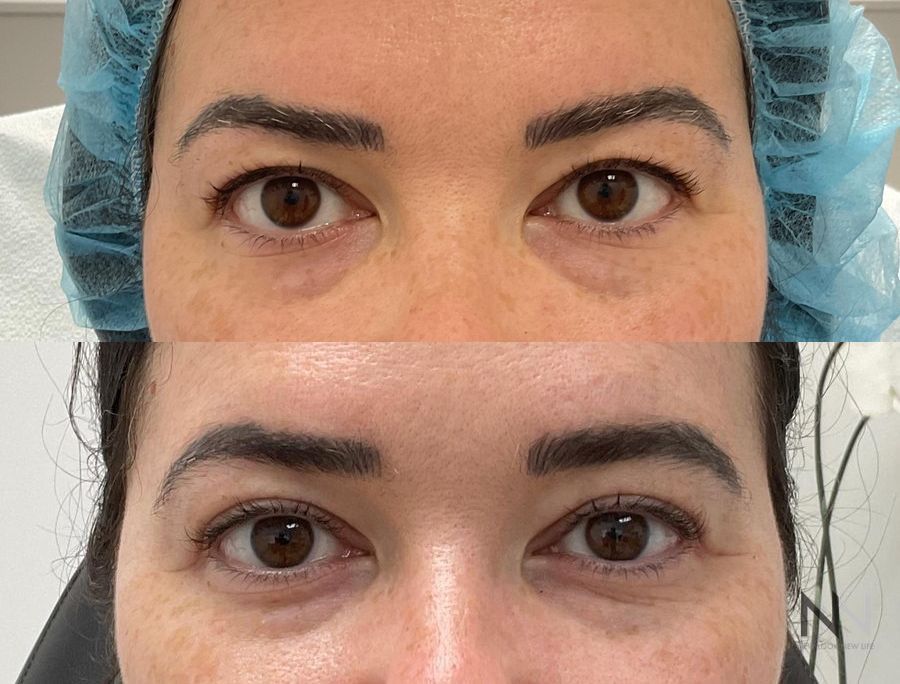 Before and after upper blepharoplasty three months results