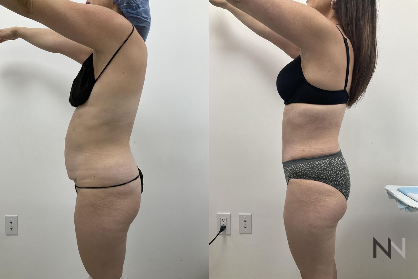 Waistline definition after abdominoplasty procedure - Angle 2