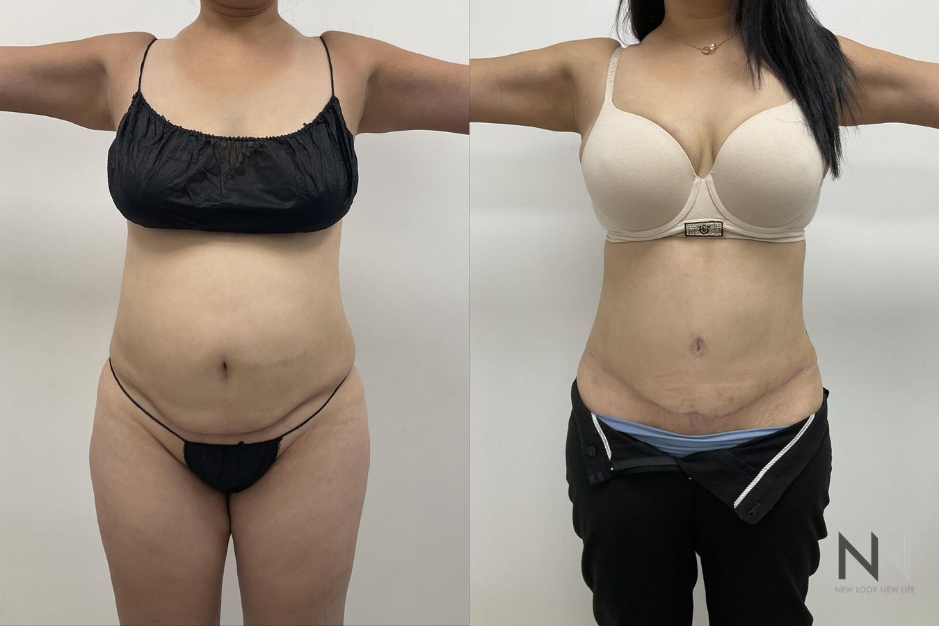 Abdominoplasty showing flatter abdomen and tighter skin