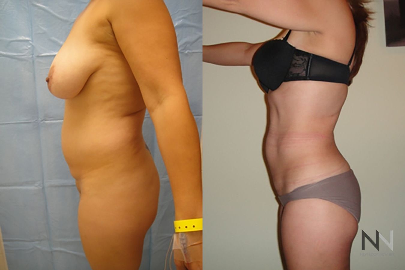 Before and after liposuction six months results - Angle 2
