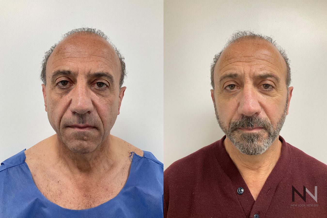 Before and after male facelift and neck lift six months results - Angle 2