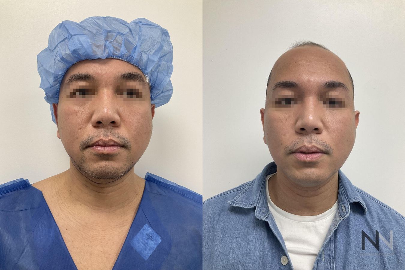 Submental liposuction showing improved jawline contour - Angle 3