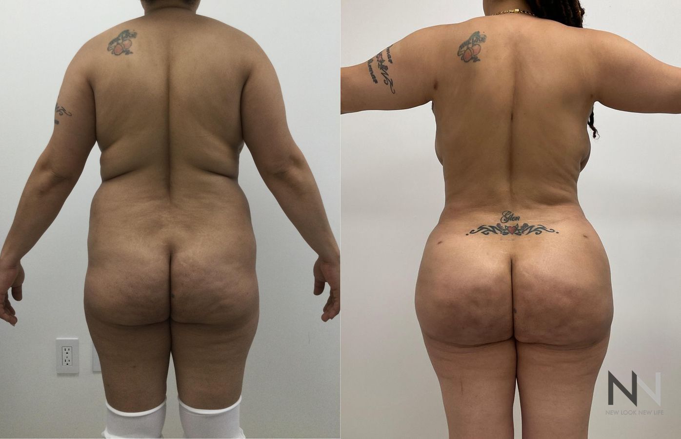 BBL showing increased buttock volume and contour