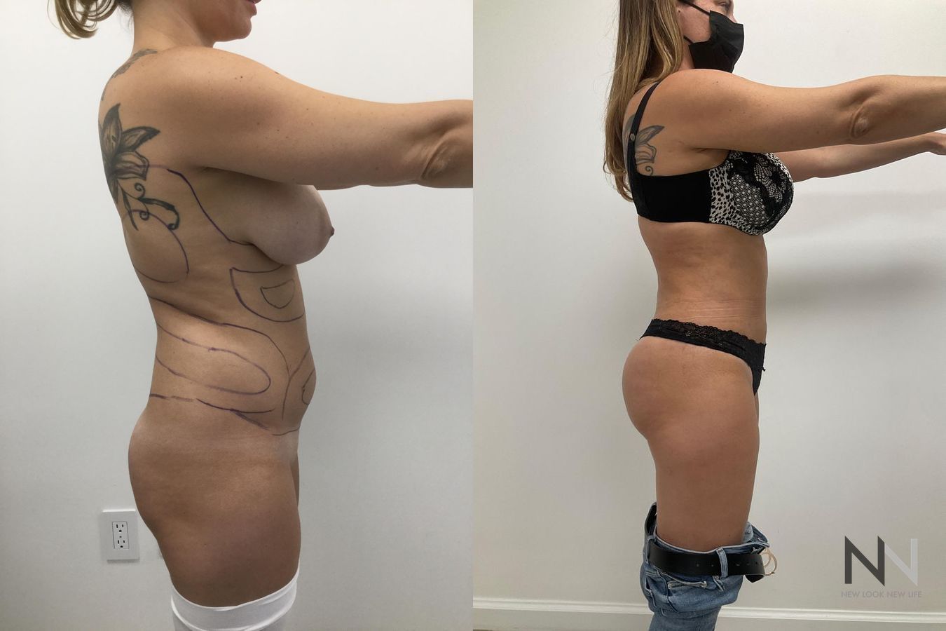Before and after Brazilian Butt Lift six months results - Angle 3