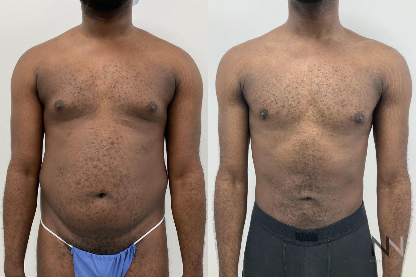 Body contouring with liposuction before and after